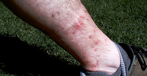 Chigger bite marks on a leg. Click to read more