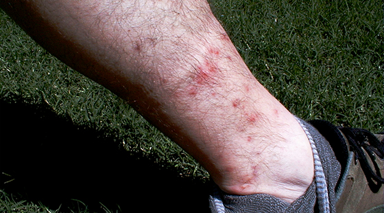 Their small size makes chiggers difficult to see as they leave behind itchy red bite marks. (Texas A&M AgriLife photo)